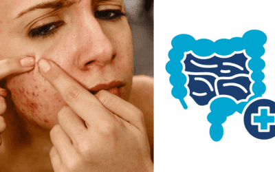 Case Study: Adult Acne triggered by gut dysbiosis