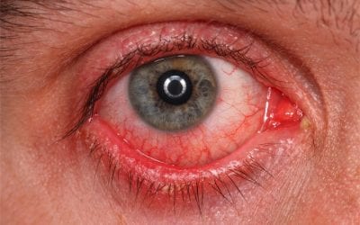 Herbal eyewash for conjunctivitis