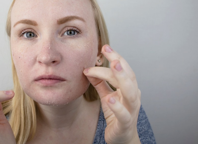woman picking at dry skin on face