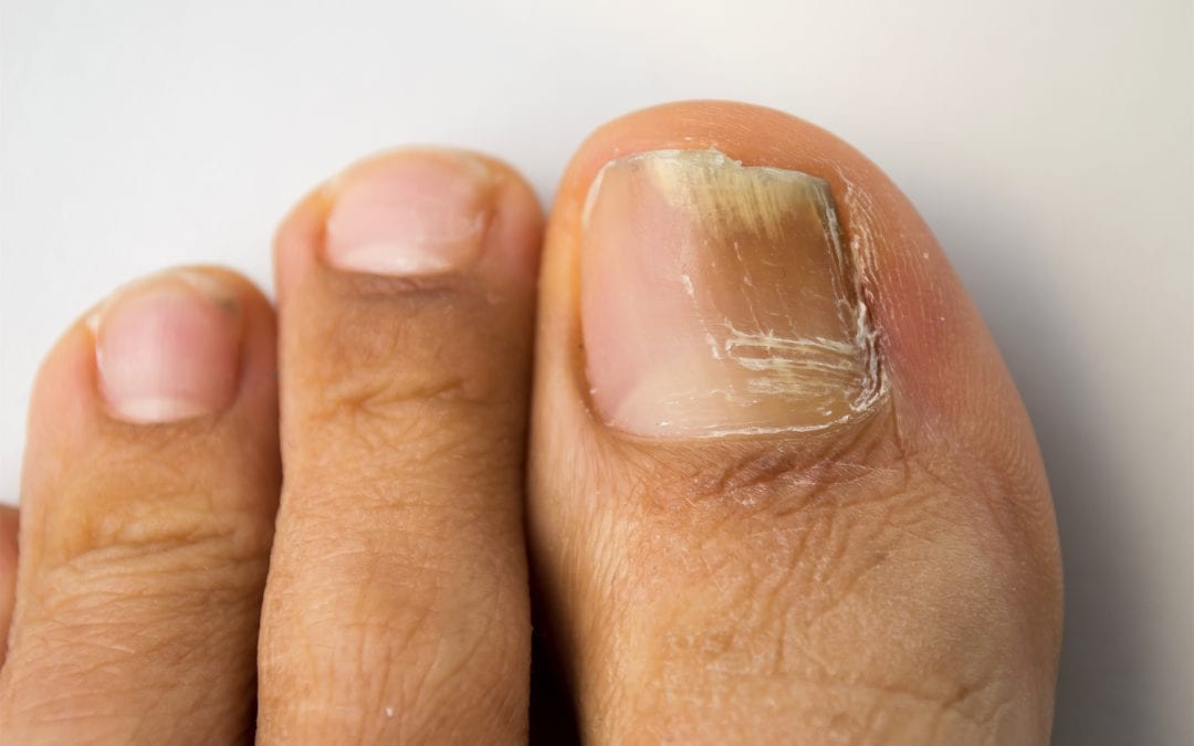 Natural treatment for fungal nail infections