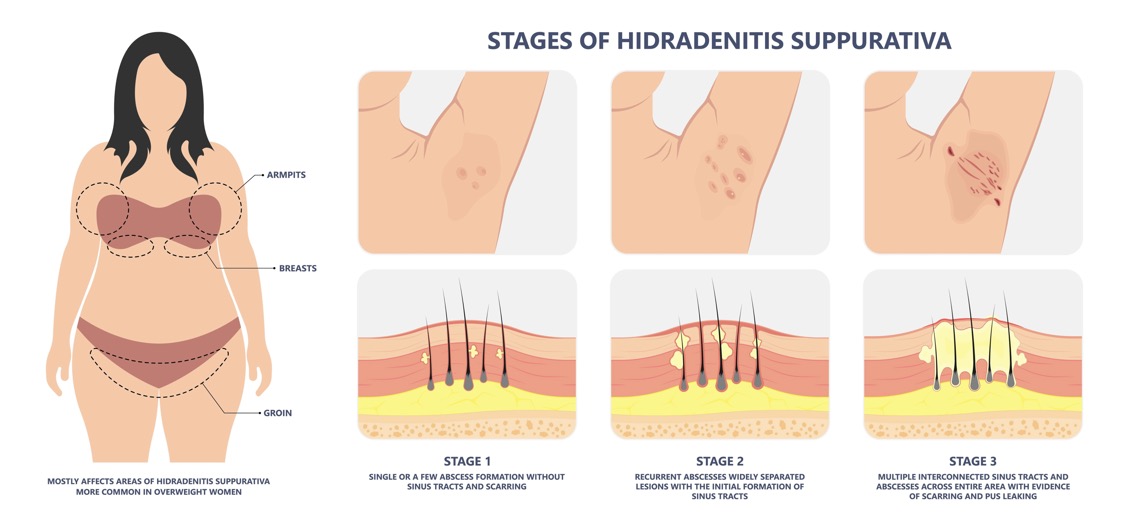 diagram of staging of hidradenitis suppurativa