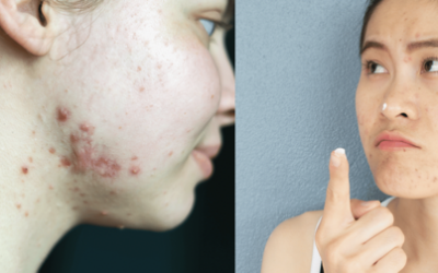 Hormonal Acne: Causes, Signs and Natural Support