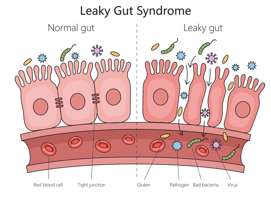 Diagram comparing a healthy gut with a leaky gut.