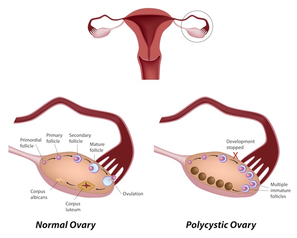 PCOS diagram