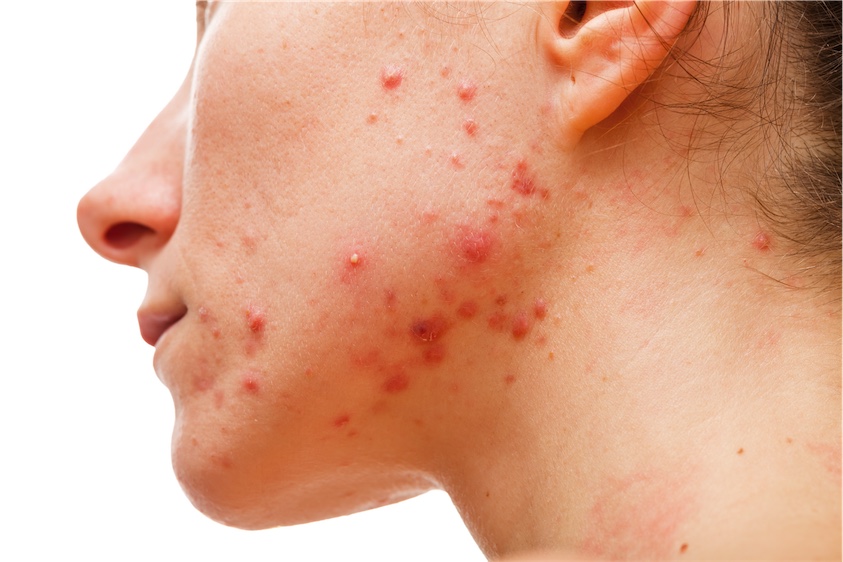 woman with jawline acne naturoapth skin conditions