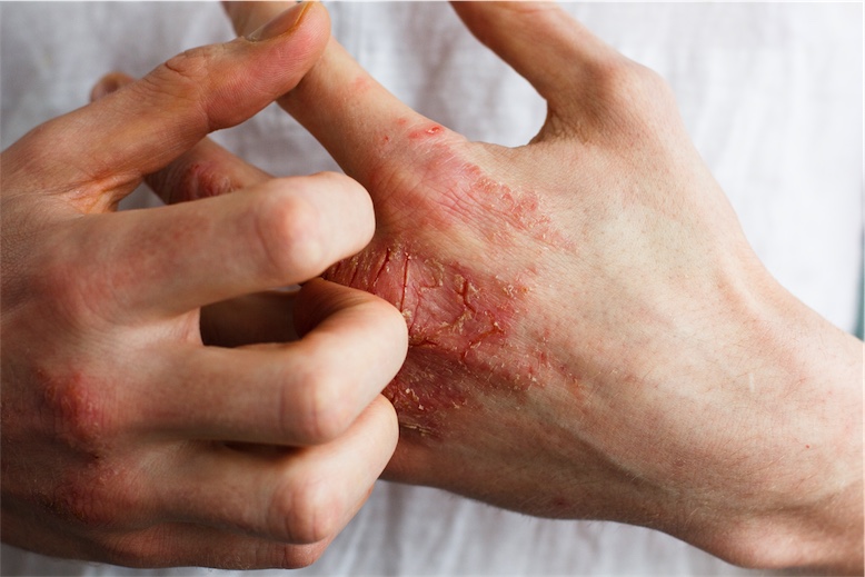 person scratching hand eczema naturopath skin conditions