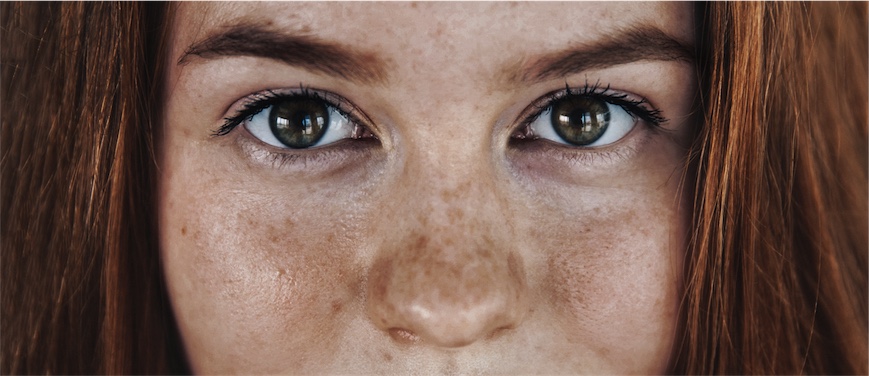 Young woman with clear skin after natural acne treatment
