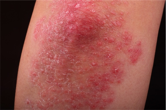 Psoriasis skin condition on knee