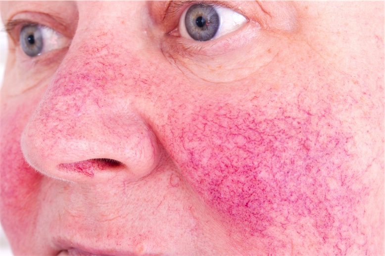 woman with rosacea on cheeks and nose