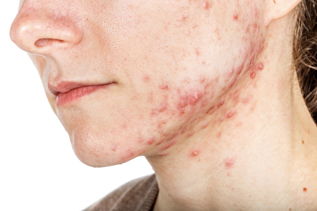 Understanding PCOS acne and what natural treatments can help