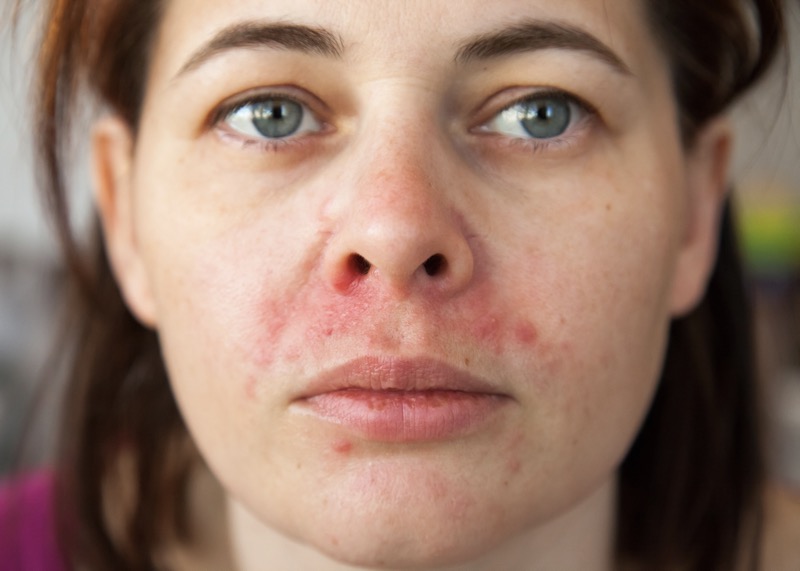 Natural treatments for perioral dermatitis