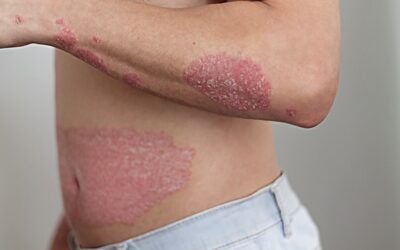 Healing the gut to treat psoriasis: the gut-skin-connection and natural treatment strategies