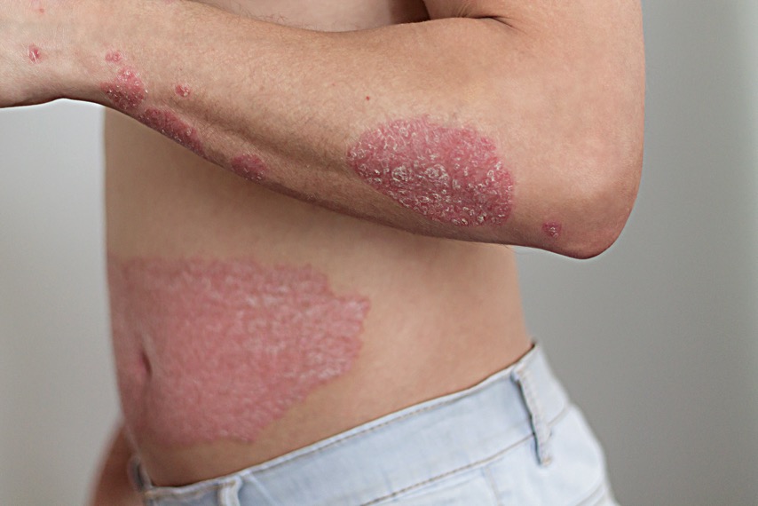 Healing the gut to treat psoriasis: the gut-skin-connection and natural treatment strategies