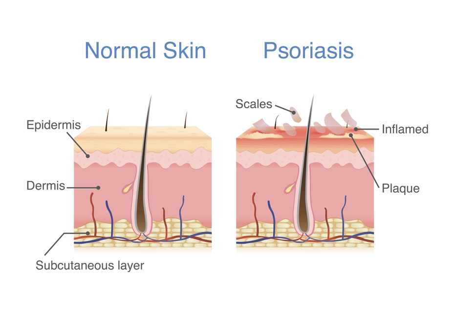 Diagram of healthy skin and psoriasis skin