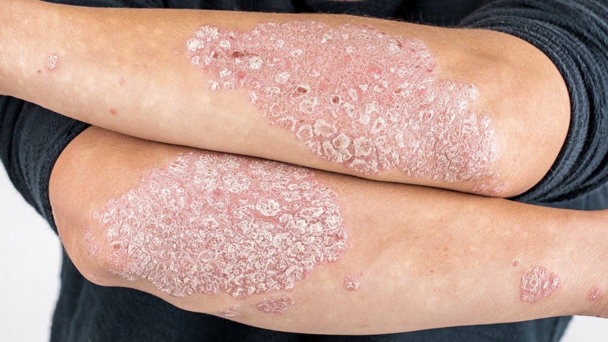 women with folded arms with psoriasis lesions on them