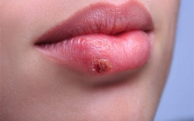 Manage cold sores naturally