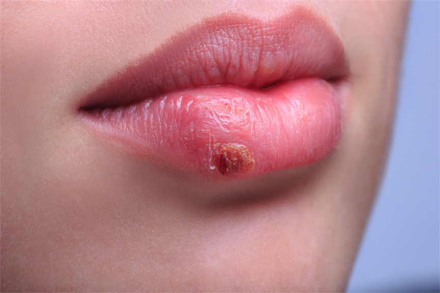 Manage cold sores naturally