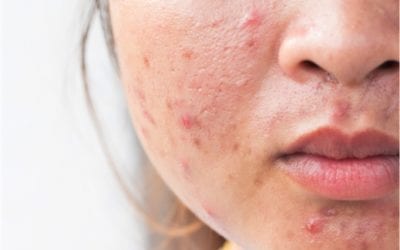 Acne: What is the underlying cause?