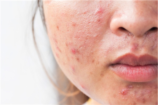 Acne: What is the underlying cause?