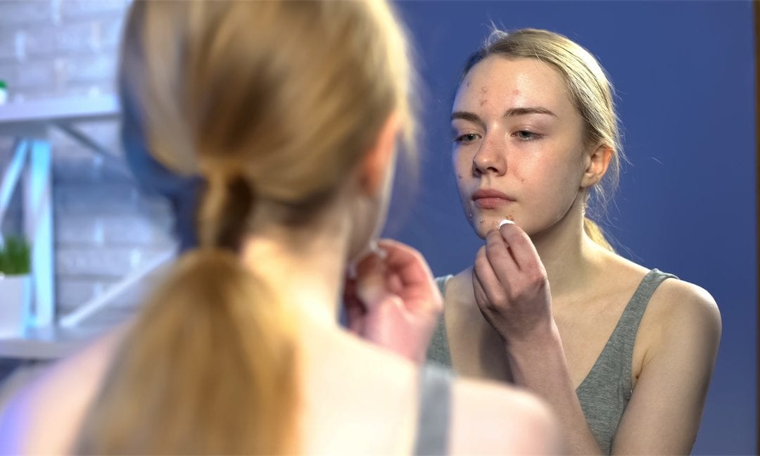 post pill acne girl in mirror, Naturopath for acne