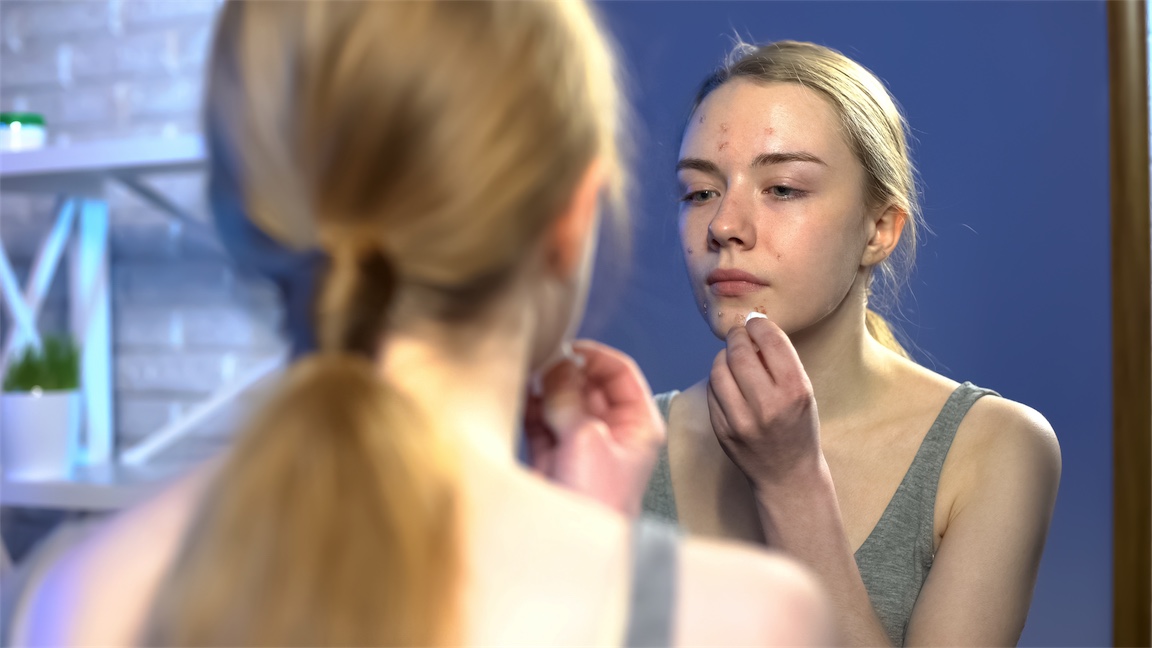 post pill acne girl in mirror, Naturopath for acne